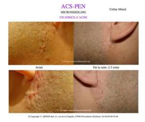 Microneedling - Cicatrices d'acné (Avant / Après)