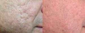 Cicatrices d'acné (avant / après)