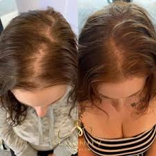 Medical JETOP - Cheveux de femme (avant / après)