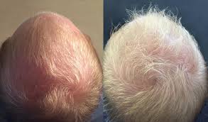 Medical JETOP - Cheveux d'homme (avant / après)